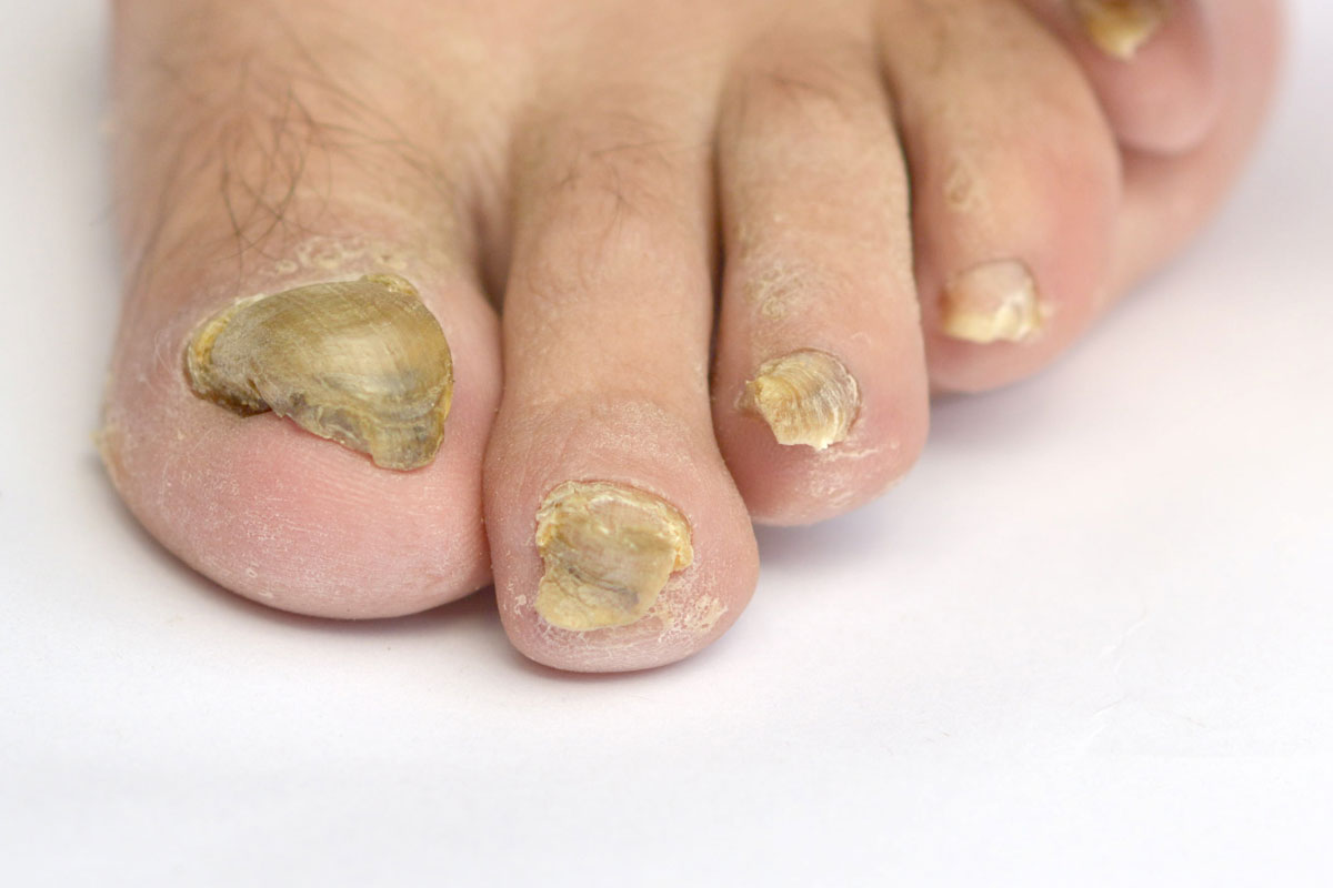 Toenail fungus treatment does not have to be ... 