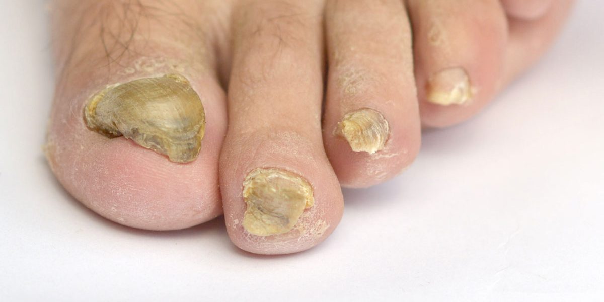 Causes and Treatments of Toenail Fungus  LifeMD