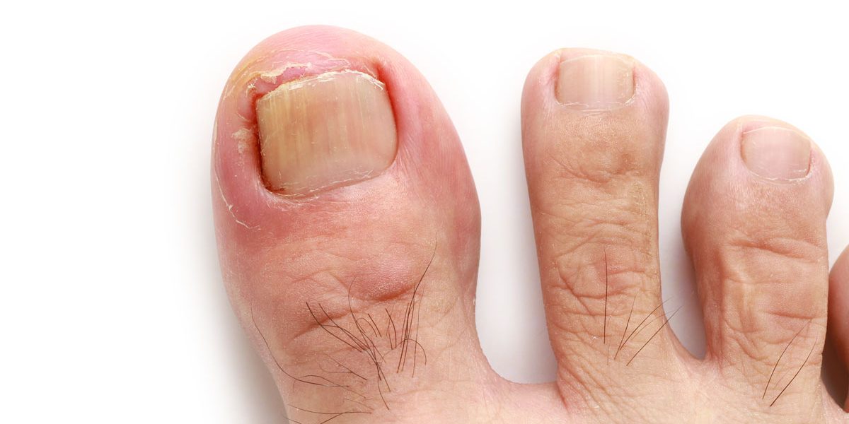 Ingrown Toenails  To Healthy Feet Podiatry